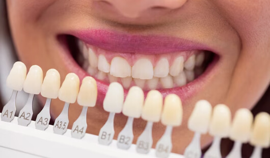انجام خدمات لمینت در کلینیک دندانپزشکی سعادت آباد